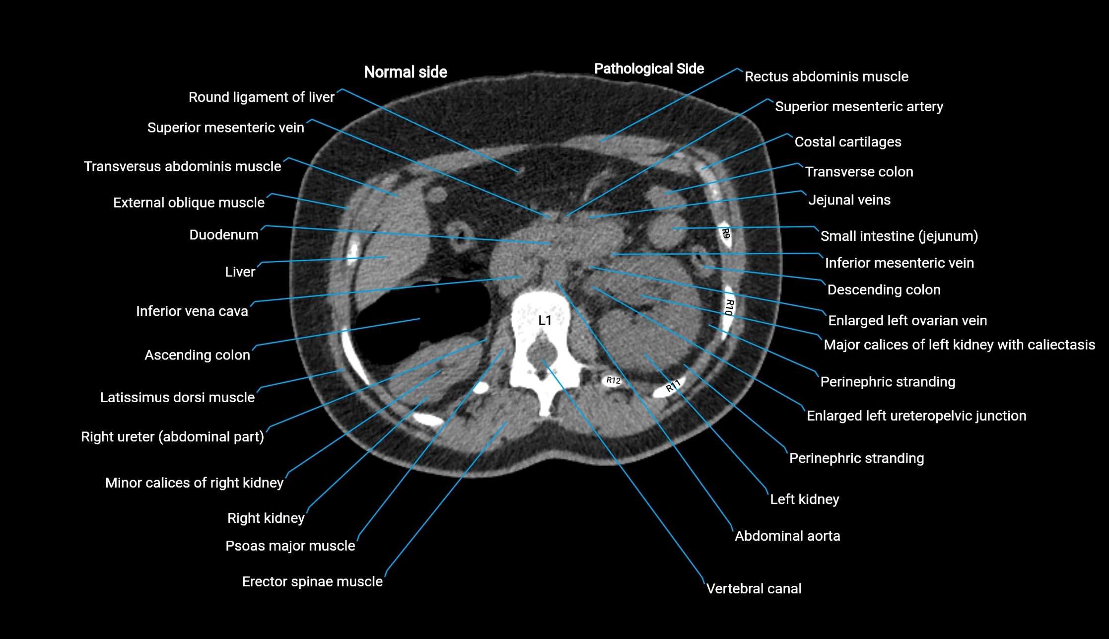 CT KUB axial cross sectional anatomy  radiology image -img-00201-00044.webp